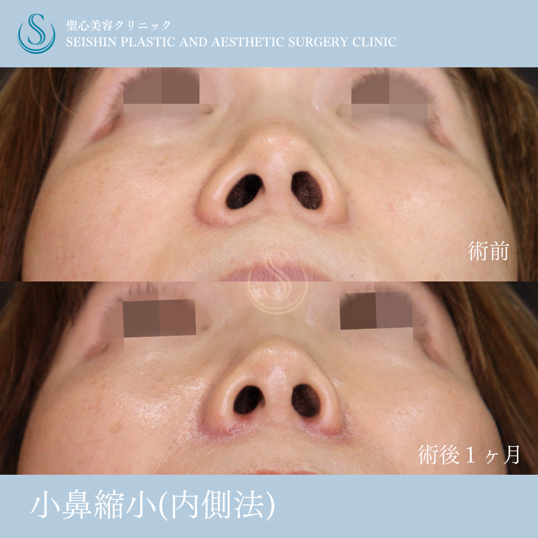 【40代女性・左右差を整え忘れ鼻に】小鼻縮小（術後1ヶ月） After 
