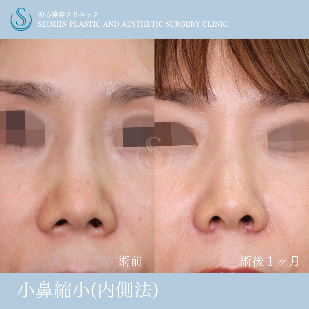 【40代女性・左右差を整え忘れ鼻に】小鼻縮小（術後1ヶ月） Before 