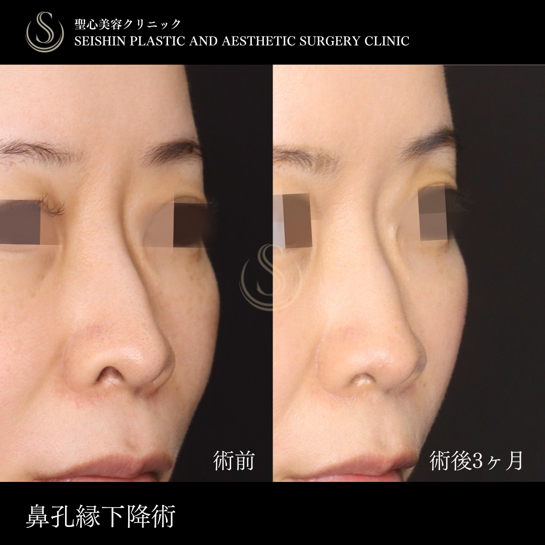 【30代女性・鼻の穴を目立ちにくく】鼻孔縁下降術（術後3ヶ月） Before 