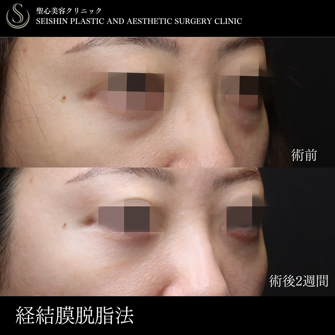 【30代女性・クマとりで目の下をスッキリ】目の下の脂肪取り（経結膜下脱脂法）（術後2週間） After 