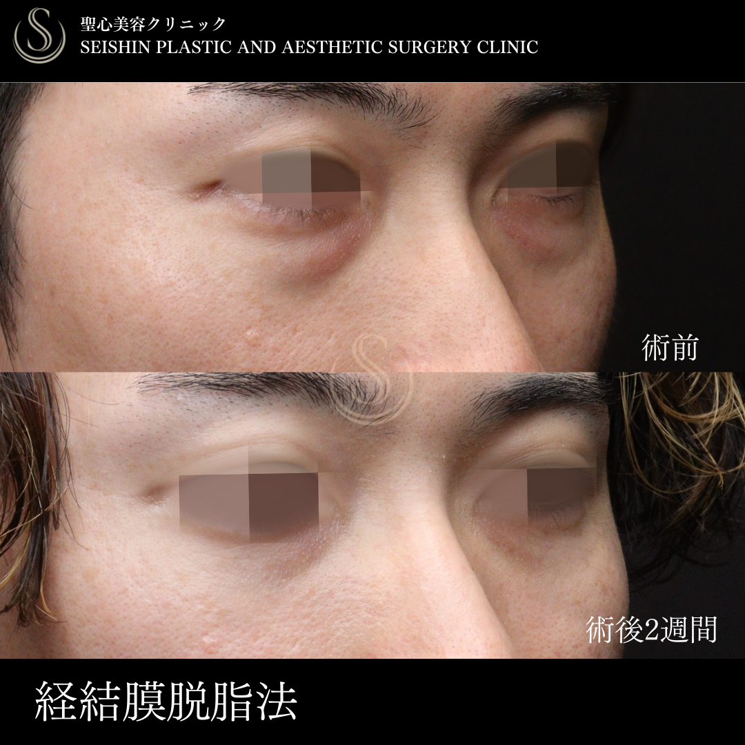 【20代男性・目の下のクマをとってスッキリ】目の下の脂肪取り（経結膜下脱脂法）（術後2週間） After 