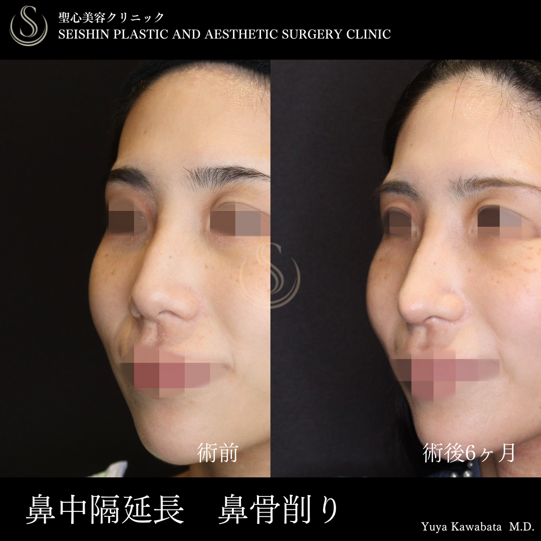 【20代女性・華やかなお鼻に】鼻中隔延長術（術後6ヶ月） After 
