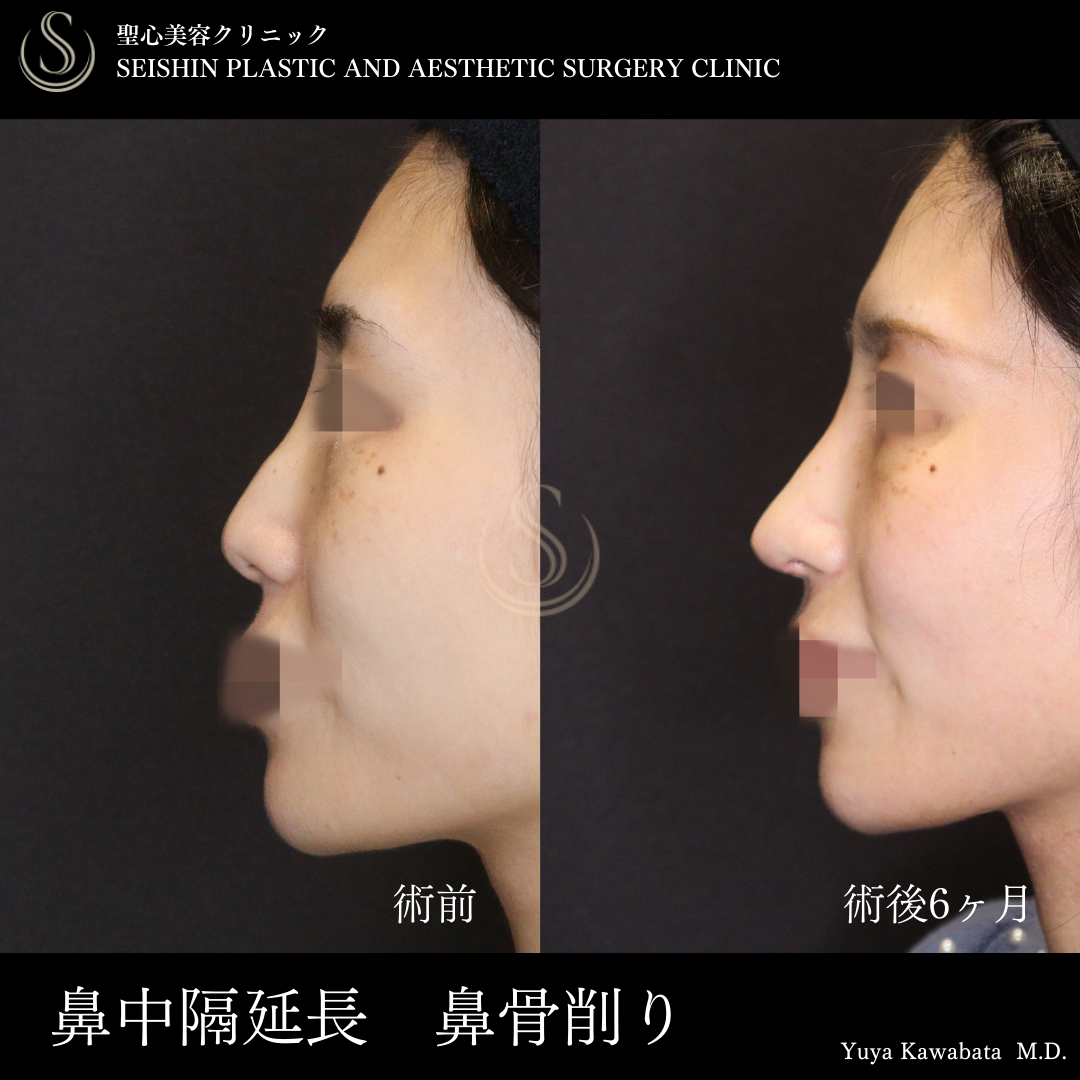 【20代女性・華やかなお鼻に】鼻中隔延長術（術後6ヶ月） Before 