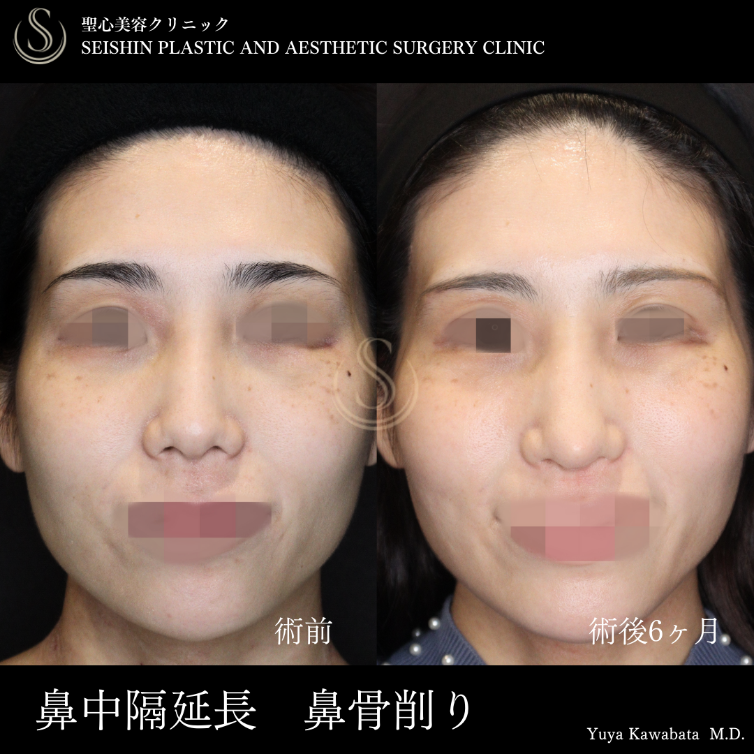 【20代女性・華やかなお鼻に】鼻中隔延長術（術後6ヶ月） After 