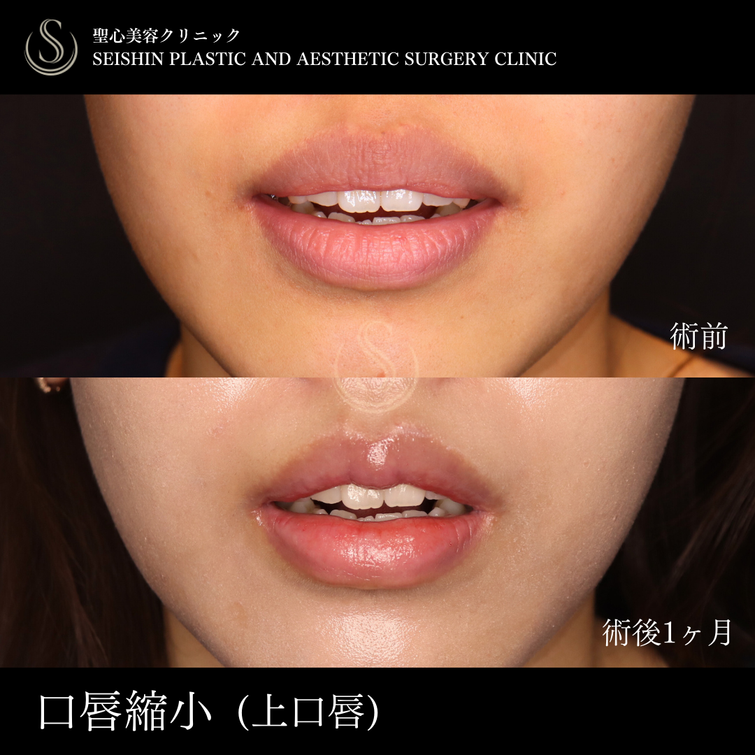 【20代女性・口唇縮小で魅力的な唇に】唇を薄くする（口唇縮小術）（術後1ヶ月） Before 