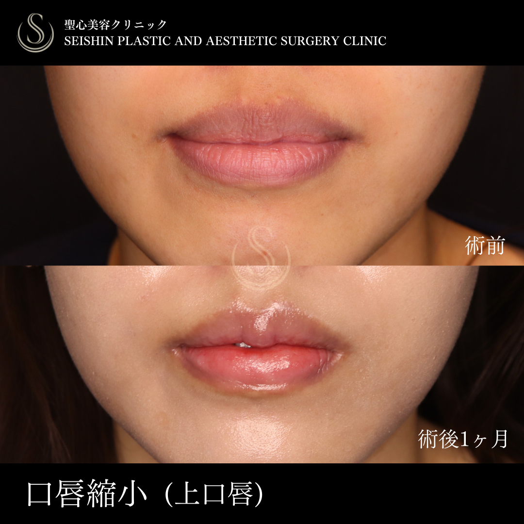 【20代女性・口唇縮小で魅力的な唇に】唇を薄くする（口唇縮小術）（術後1ヶ月） After 