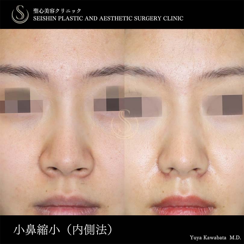 【30代女性・小鼻縮小で自然な忘れ鼻に】小鼻縮小（術後1ヶ月） Before 