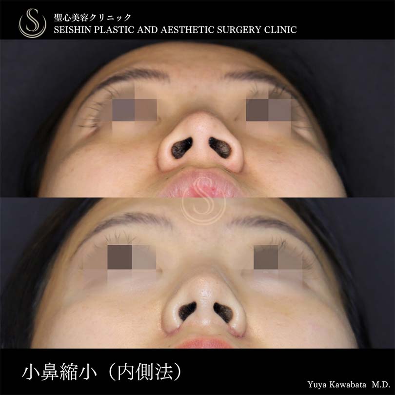 【30代女性・小鼻縮小で自然な忘れ鼻に】小鼻縮小（術後1ヶ月） After 