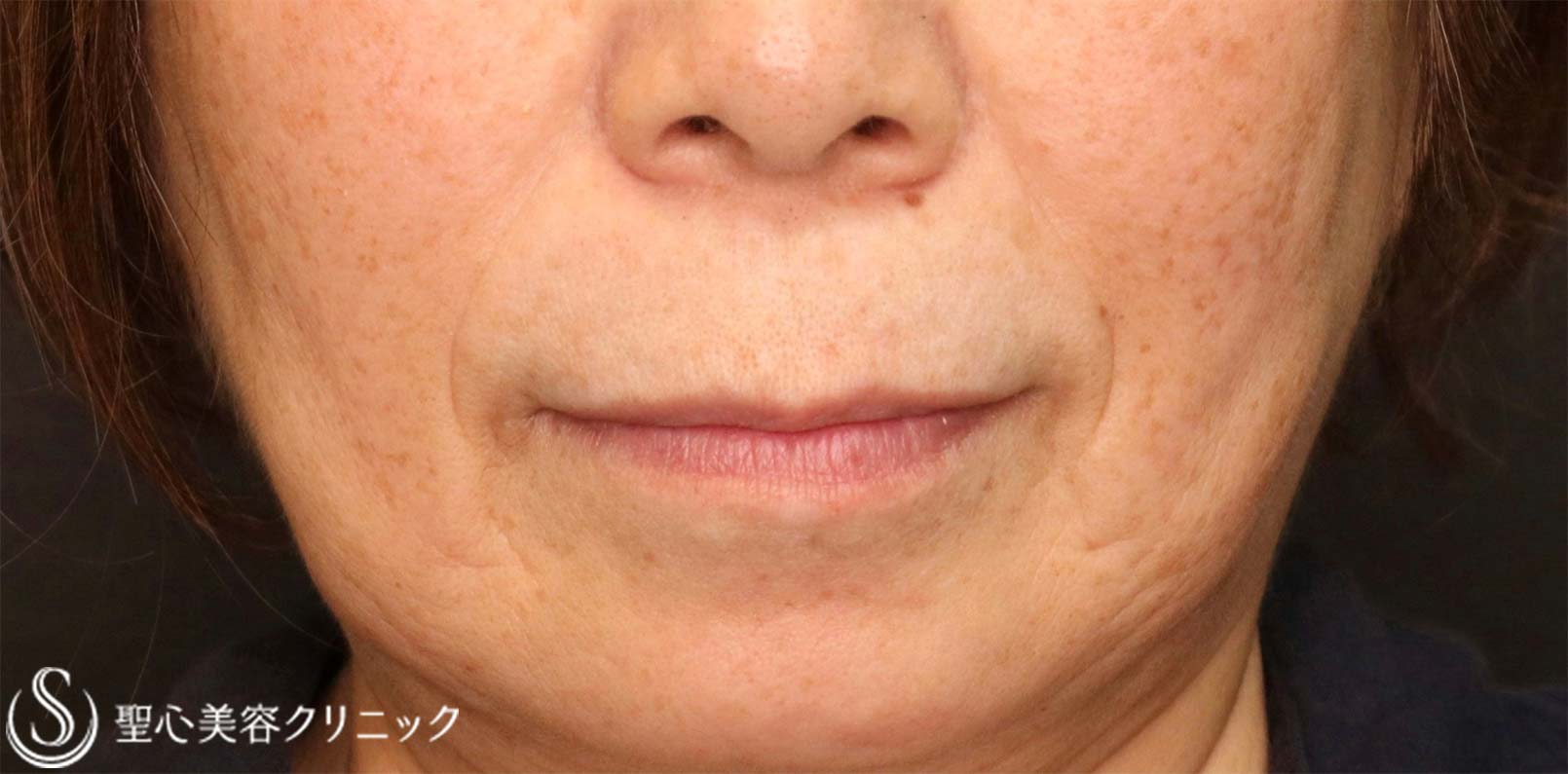【60代女性・加齢に伴い長くなった人中をできるだけバランス良く短くしたい！！】プレミアムリップリフト（プレミアム人中短縮術）（術後1ヶ月） Before 