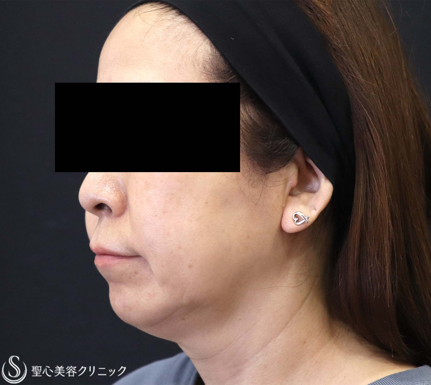 【60代女性・フェイスラインの脂肪や弛み】DENSITY（デンシティ）（1ヶ月後） Before 