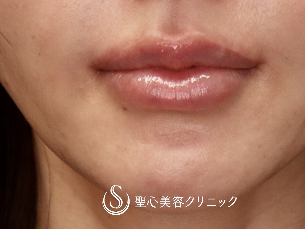 【40代女性・口角を自然に挙げて印象を良くしたい】プレミアム口角挙上術（術後1か月） After 