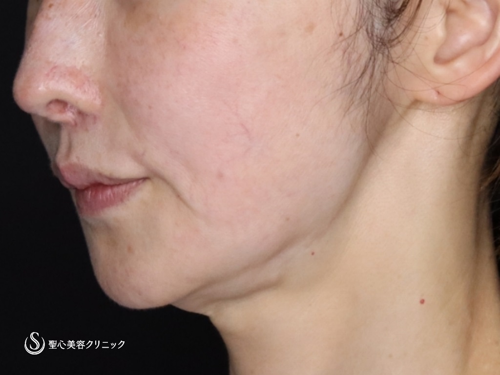 【50代女性・たるみが気になる】プレミアムミニリフト+ネックリフト+エクソソーム（歯髄）点滴（術後3か月） Before 