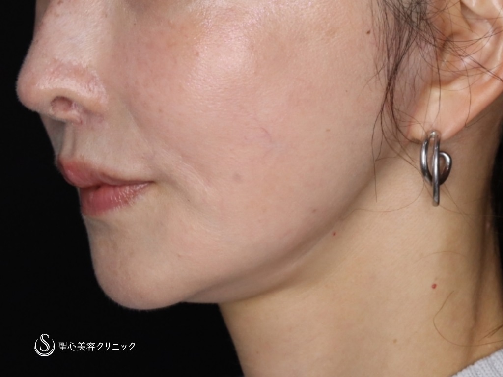 【50代女性・たるみが気になる】プレミアムミニリフト+ネックリフト+エクソソーム（歯髄）点滴（術後3か月） After 