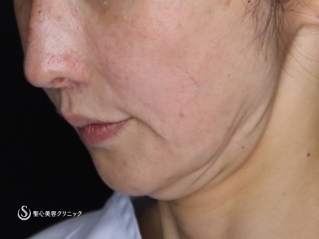 【50代女性・たるみが気になる】プレミアムミニリフト+ネックリフト+エクソソーム（歯髄）点滴（術後3か月） Before 
