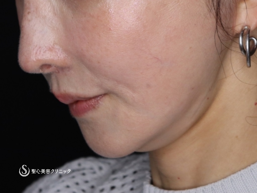 【50代女性・たるみが気になる】プレミアムミニリフト+ネックリフト+エクソソーム（歯髄）点滴（術後3か月） After 