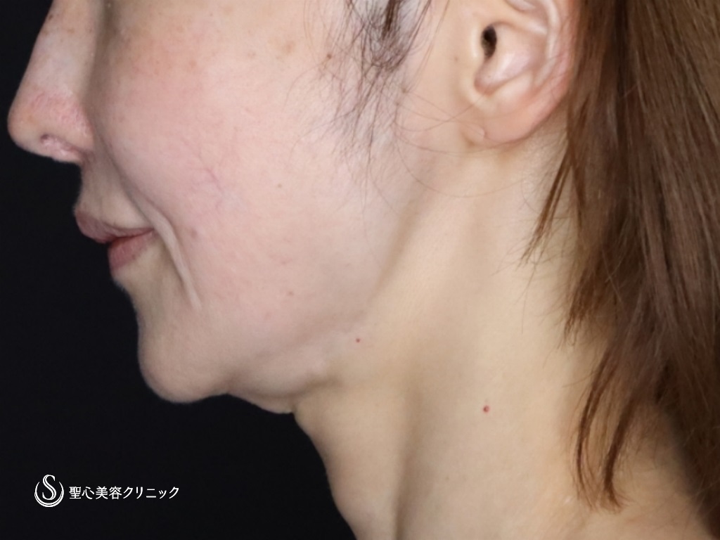 【50代女性・たるみが気になる】プレミアムミニリフト+ネックリフト+エクソソーム（歯髄）点滴（術後3か月） Before 