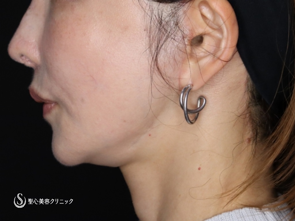 【50代女性・たるみが気になる】プレミアムミニリフト+ネックリフト+エクソソーム（歯髄）点滴（術後3か月） After 