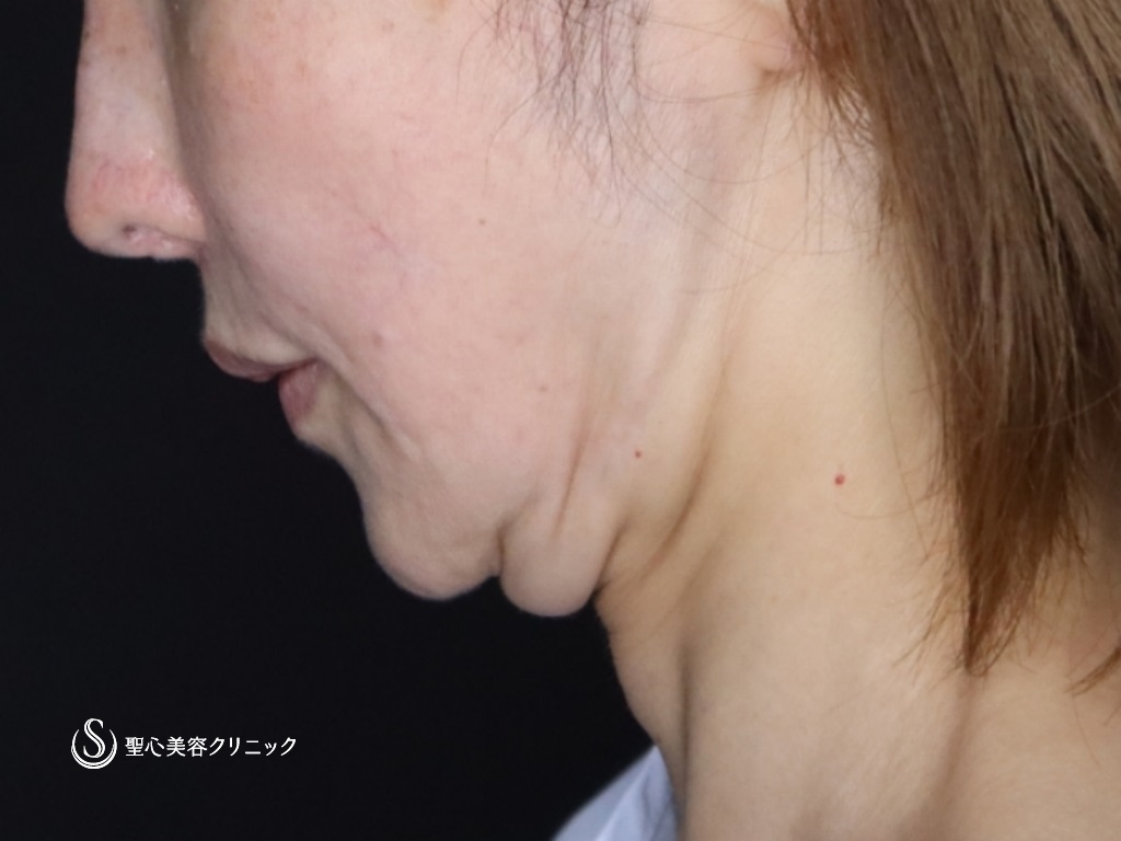【50代女性・たるみが気になる】プレミアムミニリフト+ネックリフト+エクソソーム（歯髄）点滴（術後3か月） Before 