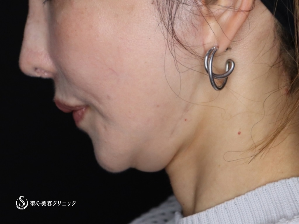 【50代女性・たるみが気になる】プレミアムミニリフト+ネックリフト+エクソソーム（歯髄）点滴（術後3か月） After 