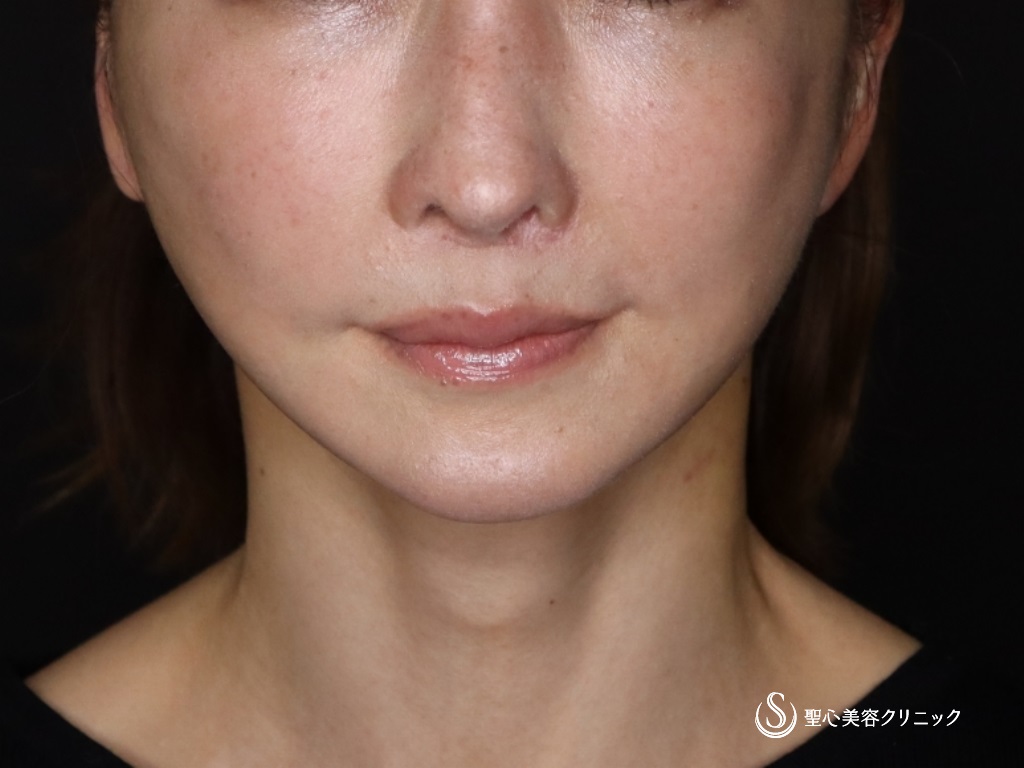 【50代女性・たるみが気になる】プレミアムミニリフト+ネックリフト+エクソソーム（歯髄）点滴（術後3か月） Before 