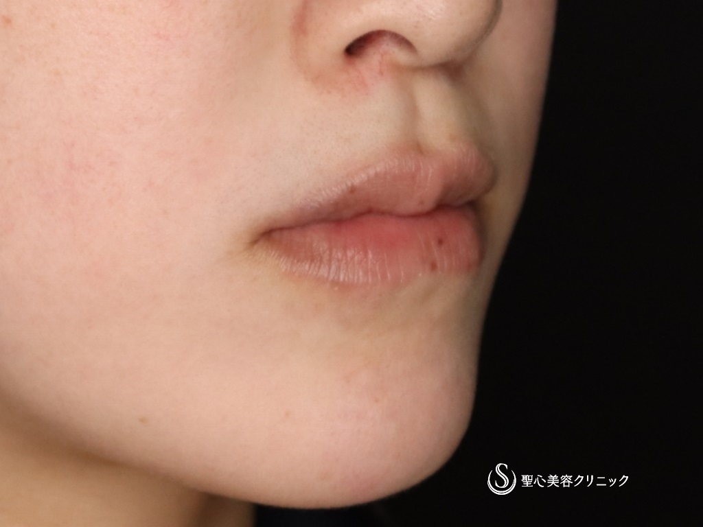 【20代女性・口角を挙げて印象を良くしたい】プレミアム口角挙上術（術後1か月） Before 