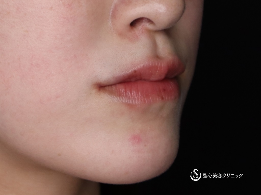 【20代女性・口角を挙げて印象を良くしたい】プレミアム口角挙上術（術後1か月） After 