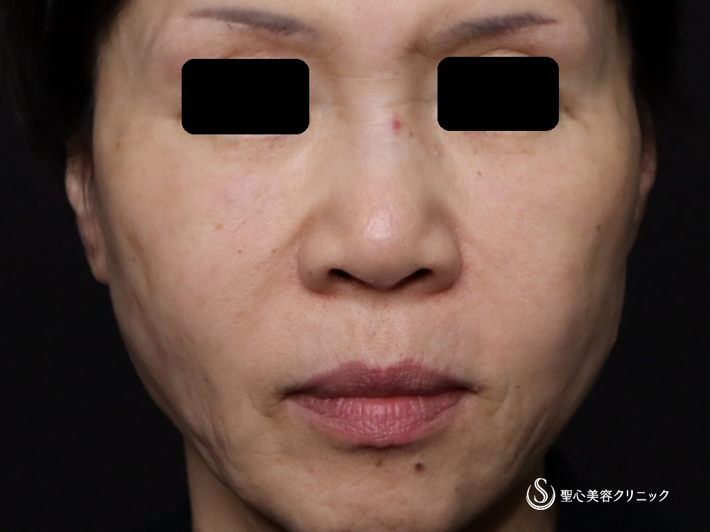 【60代女性・口元のたるみ、頬位置の改善】アンカーX（術後2週間） Before 