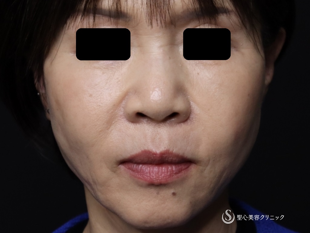 【60代女性・口元のたるみ、頬位置の改善】アンカーX（術後2週間） After 