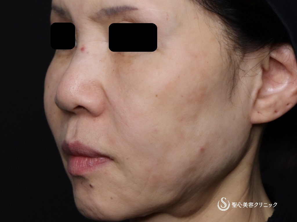 【60代女性・口元のたるみ、頬位置の改善】アンカーX（術後2週間） Before 