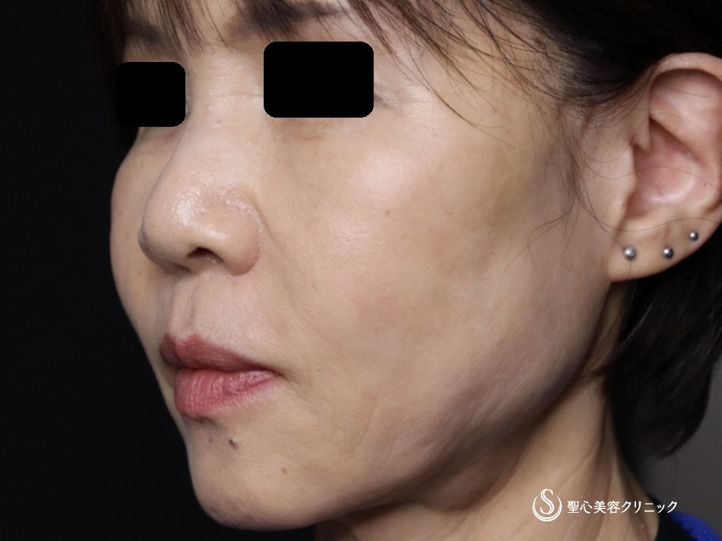 【60代女性・口元のたるみ、頬位置の改善】アンカーX（術後2週間） After 