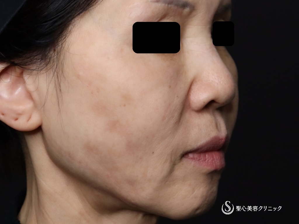 【60代女性・口元のたるみ、頬位置の改善】アンカーX（術後2週間） Before 