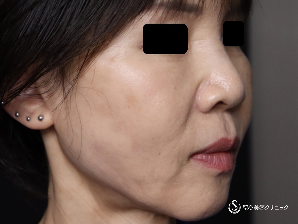【60代女性・口元のたるみ、頬位置の改善】アンカーX（術後2週間） After 