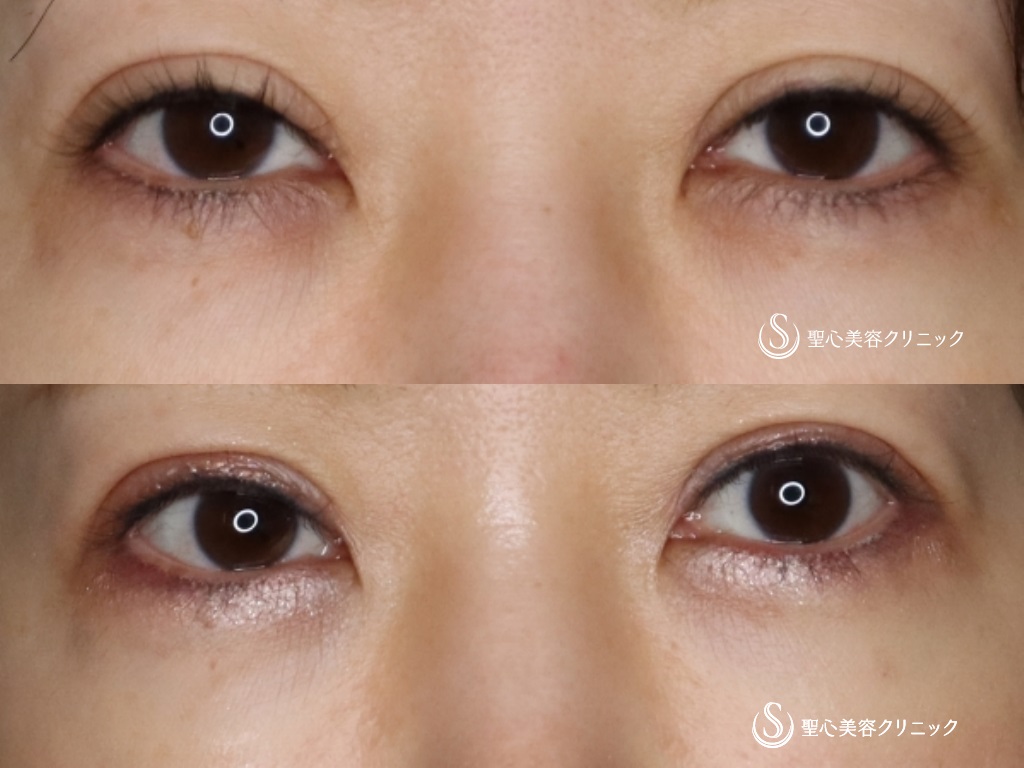 【40代女性・二重幅を狭くして、ハム目を改善したい】睫毛上皮膚切除（術後1か月） After 