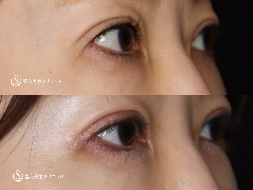 【40代女性・二重幅を狭くして、ハム目を改善したい】睫毛上皮膚切除（術後1か月） After 
