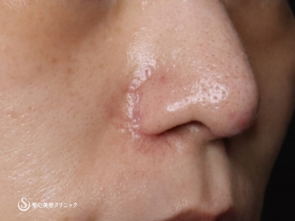 【40代女性・他院修正】小鼻縮小+オステオポール除去+鼻尖縮小+鼻先耳介軟骨移植（1か月後） After 