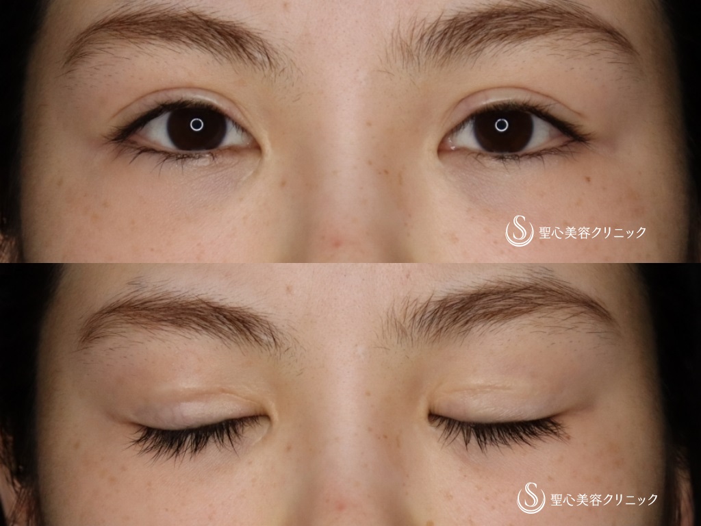 【20代女性・二重を綺麗にしたい】睫毛上皮膚切除（ハム目修正）（1か月後） Before 