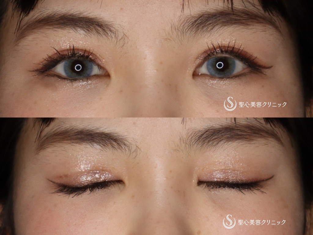 【20代女性・二重を綺麗にしたい】睫毛上皮膚切除（ハム目修正）（1か月後） After 