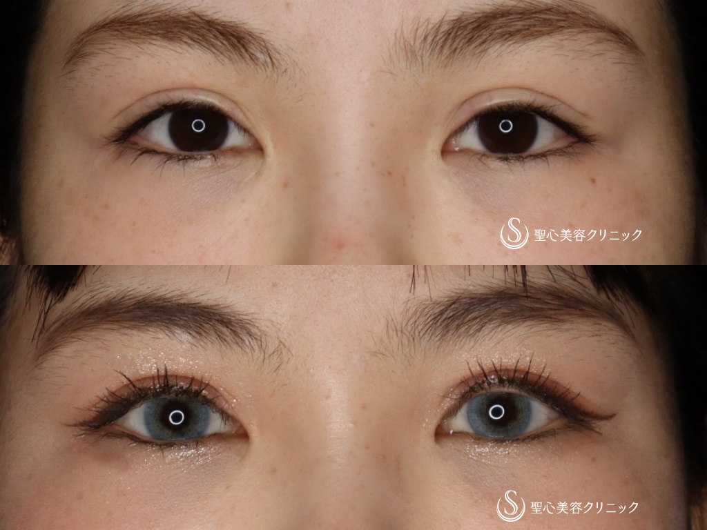 【20代女性・二重を綺麗にしたい】睫毛上皮膚切除（ハム目修正）（1か月後） After 
