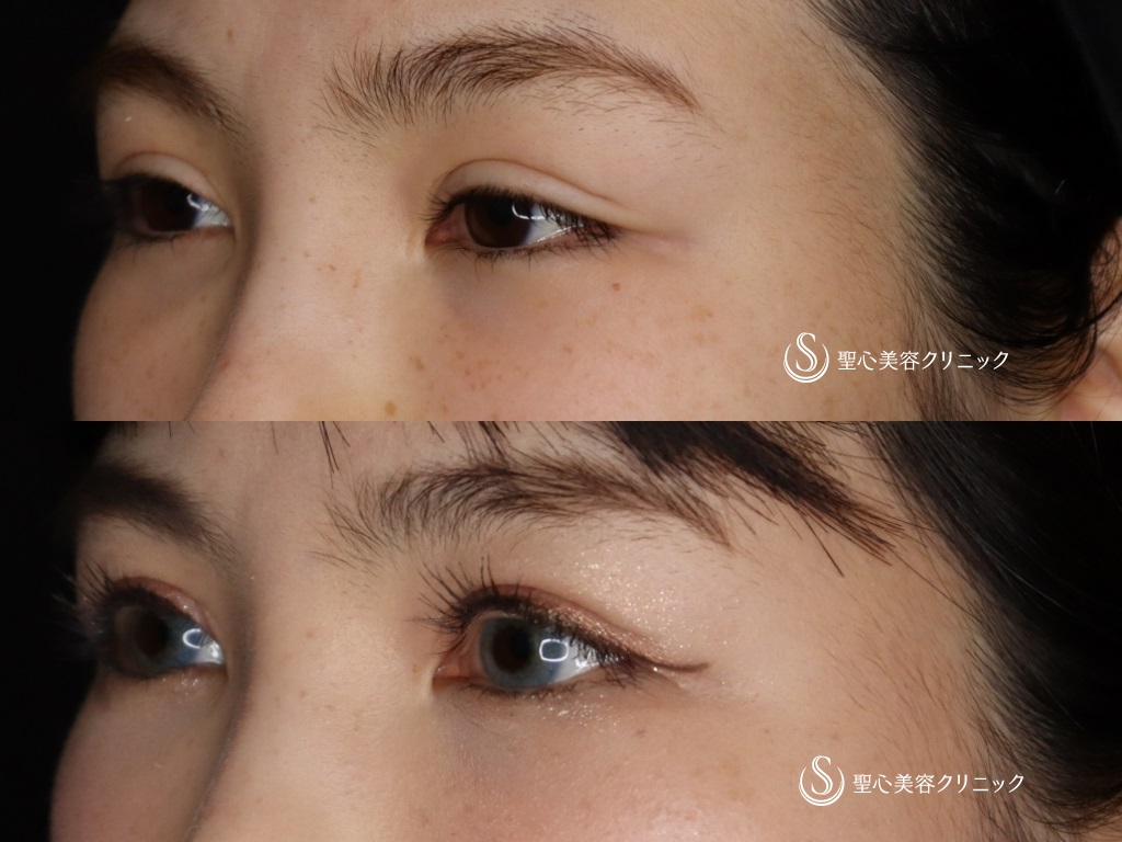 【20代女性・二重を綺麗にしたい】睫毛上皮膚切除（ハム目修正）（1か月後） After 