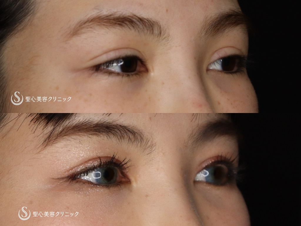 【20代女性・二重を綺麗にしたい】睫毛上皮膚切除（ハム目修正）（1か月後） After 