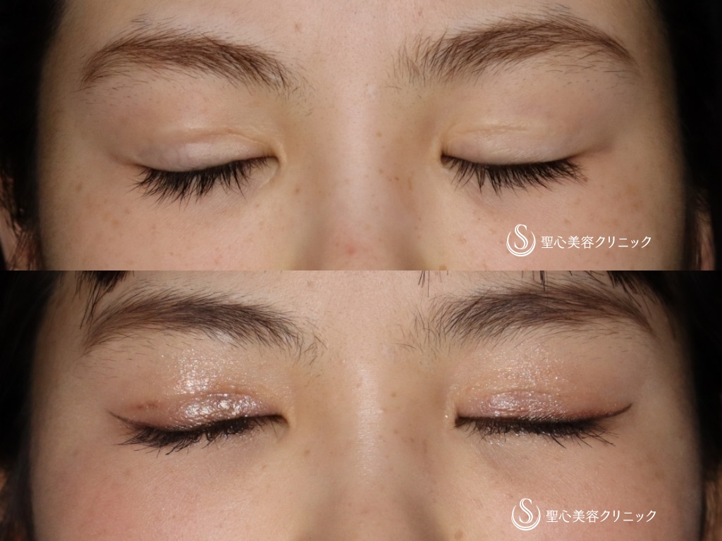 【20代女性・二重を綺麗にしたい】睫毛上皮膚切除（ハム目修正）（1か月後） After 