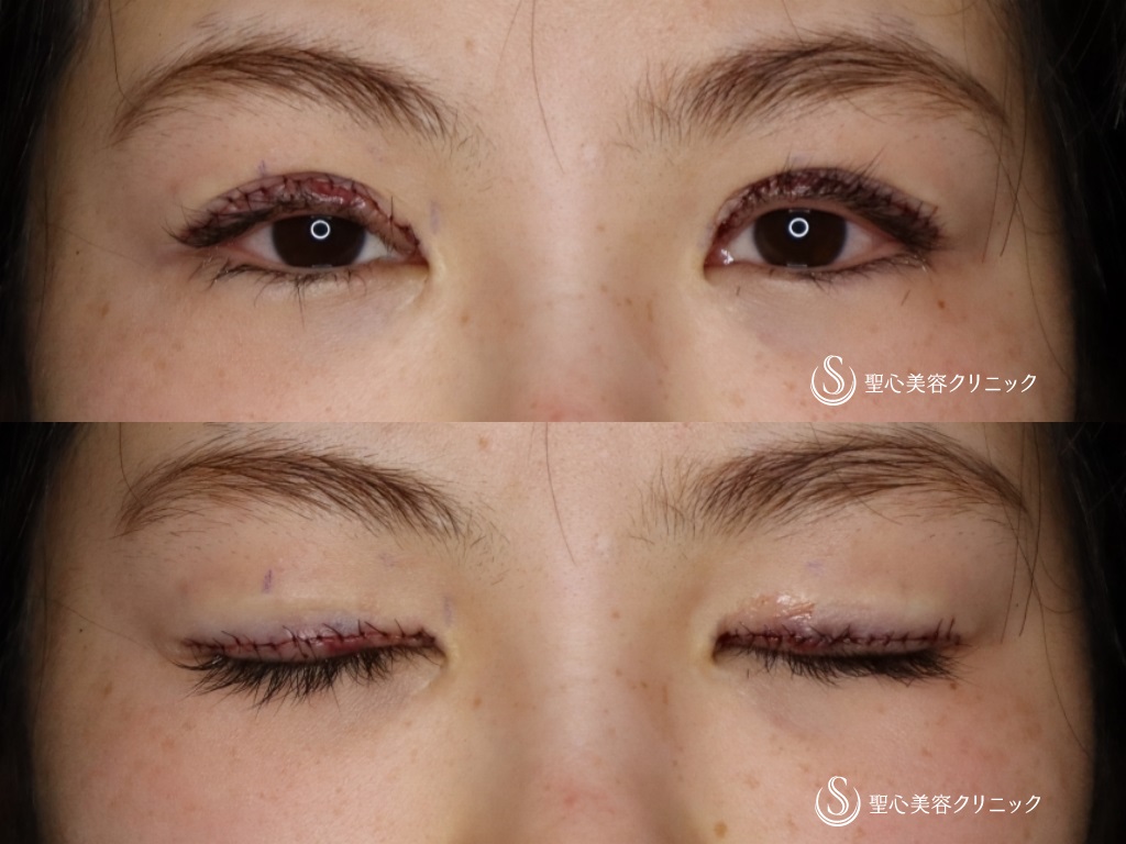 【20代女性・二重を綺麗にしたい】睫毛上皮膚切除（ハム目修正）（1か月後） Before 