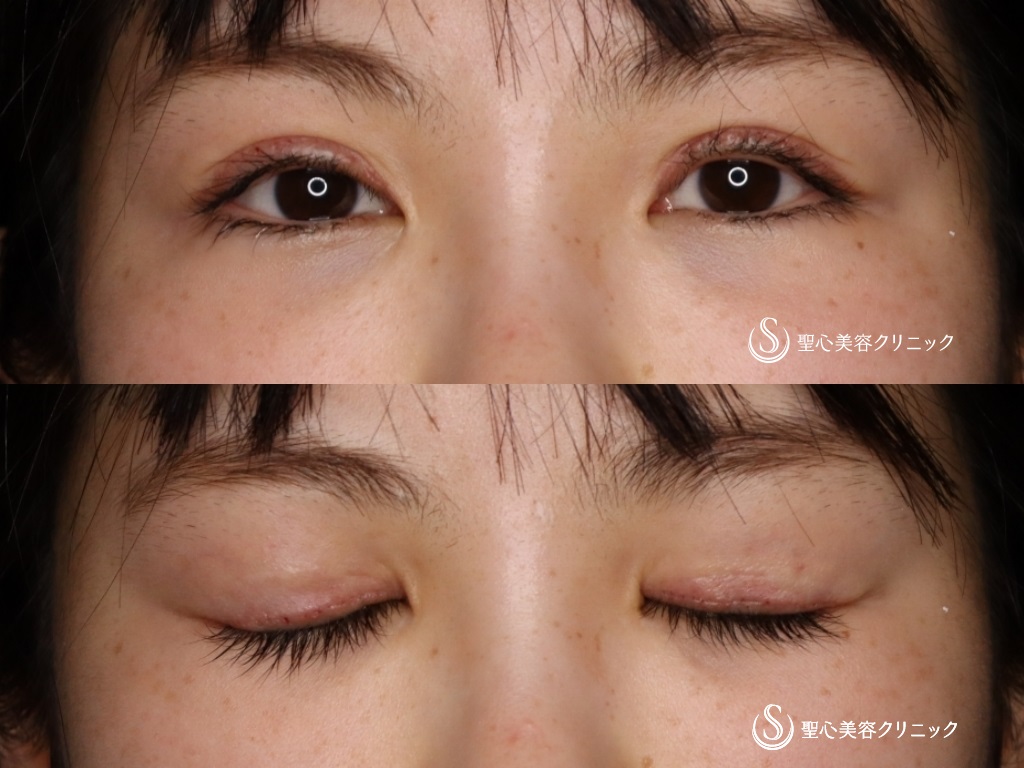 【20代女性・二重を綺麗にしたい】睫毛上皮膚切除（ハム目修正）（1か月後） Before 