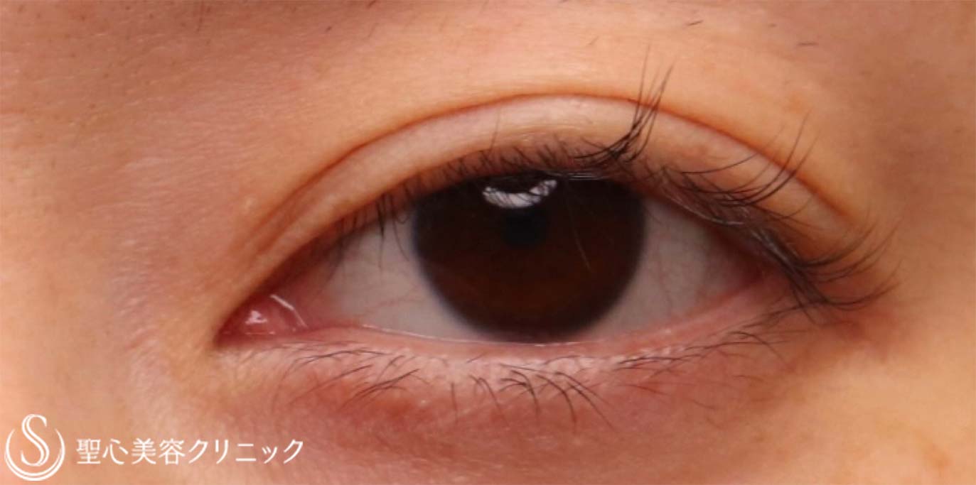 【30代女性・ハム目を改善したい！！】睫毛上皮膚切開（術後1ヶ月） Before 