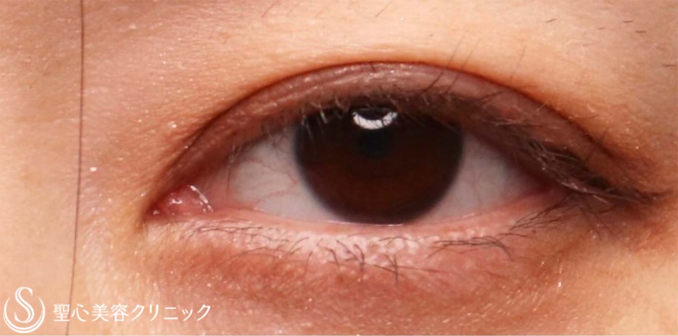 【30代女性・ハム目を改善したい！！】睫毛上皮膚切開（術後1ヶ月） After 
