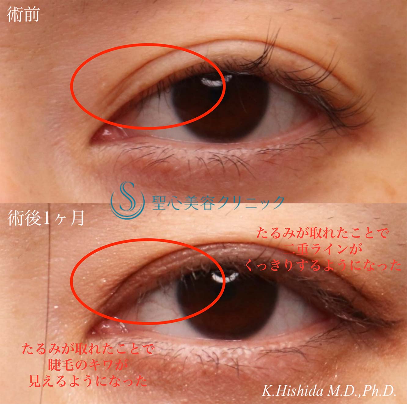 【30代女性・ハム目を改善したい！！】睫毛上皮膚切開（術後1ヶ月） After 