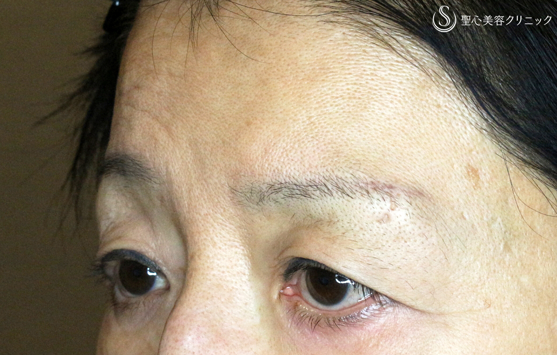 【60代女性・ベル麻痺+まぶたのたるみ】眉下リフト＆右額ボトックス（7年9ヶ月後） Before 