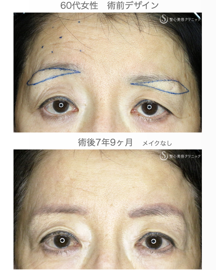 【60代女性・ベル麻痺+まぶたのたるみ】眉下リフト＆右額ボトックス（7年9ヶ月後） After 