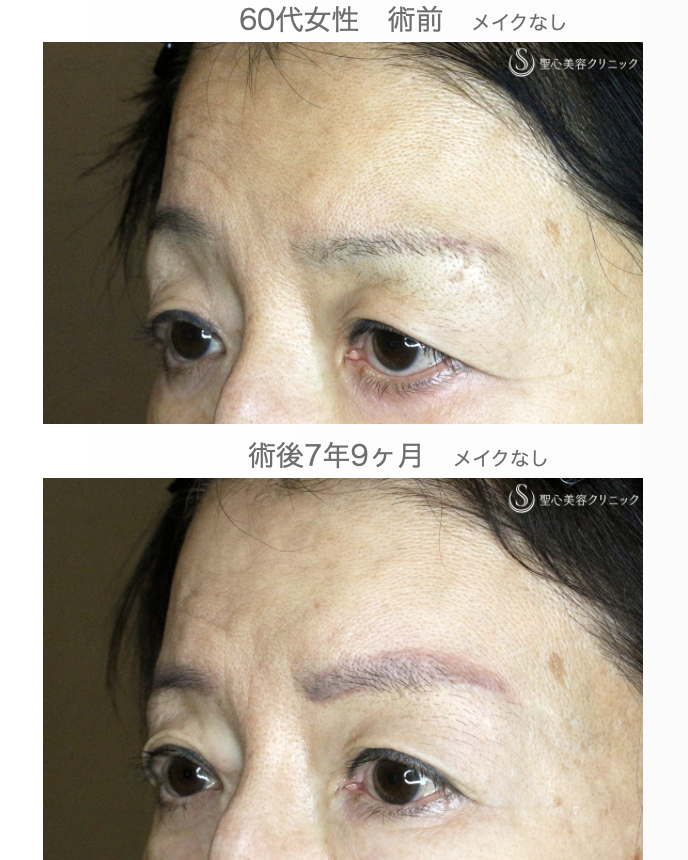 【60代女性・ベル麻痺+まぶたのたるみ】眉下リフト＆右額ボトックス（7年9ヶ月後） After 