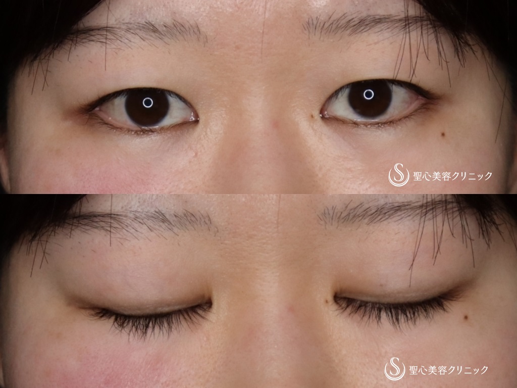 【20代女性・傷の目立ちにくいリドレープ法】目頭切開（1か月後） Before 